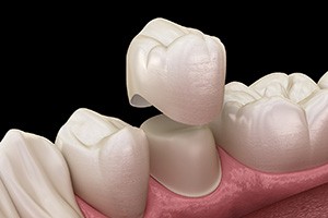 a closeup of the dental crown process in South Edmonton