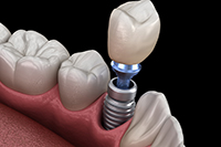 a patient with dental implants in Edmonton, AB