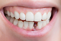 A single-tooth implant