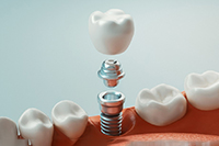 A 3D illustration of dental implant parts